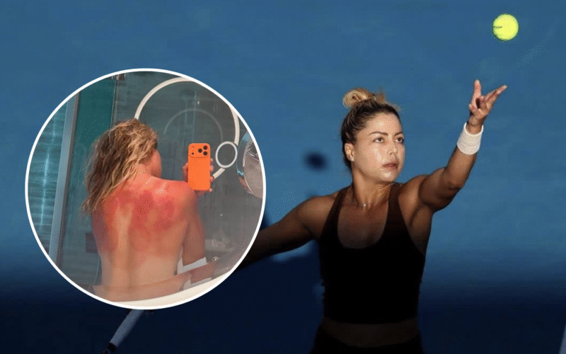 Renata Zarazúa sufre quemaduras por el excesivo sol de Australia. Captura de pantalla.